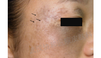 laser微博_candelalaser_laser