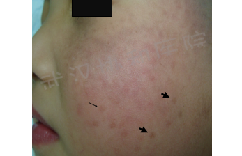 candelalaser_laser_laser微博