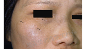 laser微博_laser_candelalaser