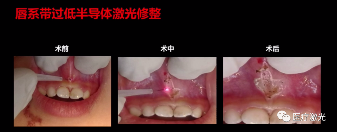laser虚拟男团_laser是什么意思_laser